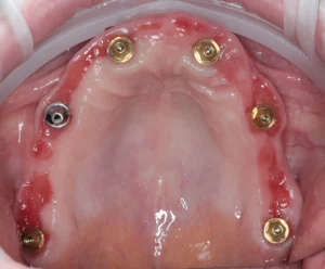 Імплантація зубів all-on-6 в Ужгороді - стоматологія PICASSO, адреса: вул. Бабʼяка (Бобяка), 1Б, ЖК «Crystal», телефон +38 097 247 57 47