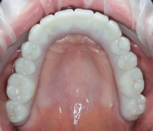 Імплантація зубів в Ужгороді - стоматологія PICASSO, адреса: вул. Бабʼяка (Бобяка), 1Б, ЖК «Crystal», телефон +38 097 247 57 47